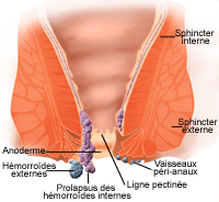 Chirurgie hemorroides Tunisie - types d'affection anales