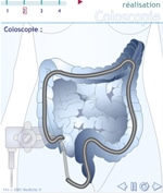 La coloscopie