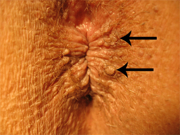 Condylomes