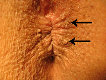 Les condylomes - Nancy Gastro