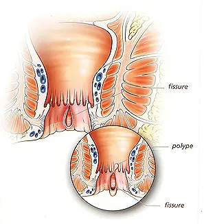 Fissures