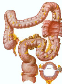 La diverticulose sigmoïdienne - Nancy Gastro